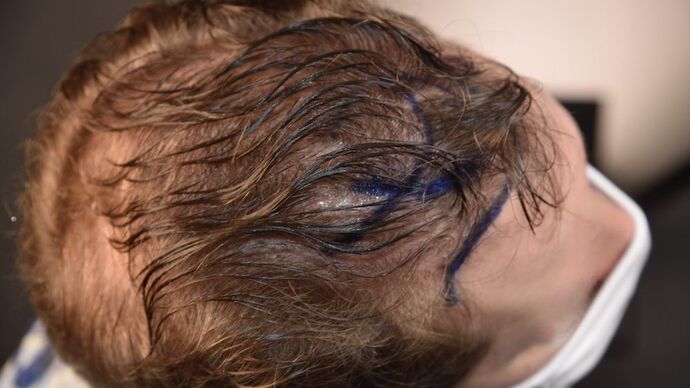 FUT Hair Restoration: Case 10 - Before