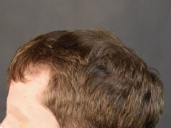 FUT Hair Restoration: Case 10 - After