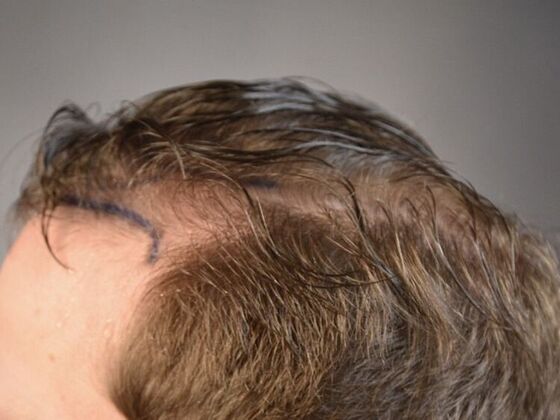 FUT Hair Restoration: Case 10 - Before