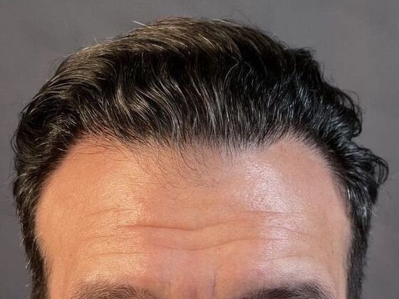 FUT Hair Restoration Case 11 - After