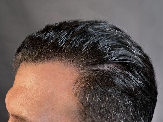 FUT Hair Restoration: Case 11 - After