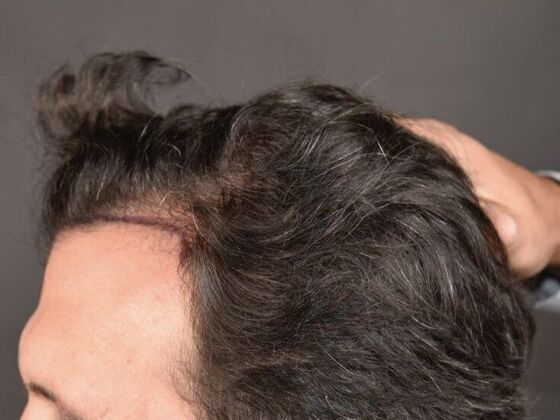 FUT Hair Restoration: Case 11 - Before