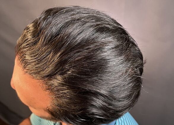 FUT Hair Restoration: Case 11 - After