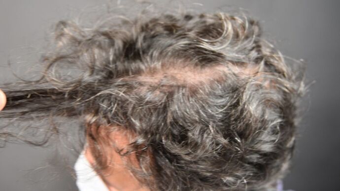 FUT Hair Restoration: Case 11 - Before