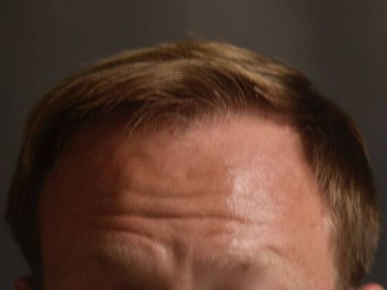 FUT Hair Restoration: Case 12 - After