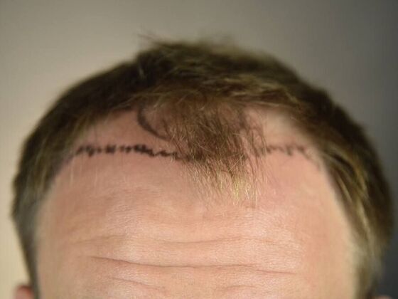 FUT Hair Restoration: Case 12 - Before