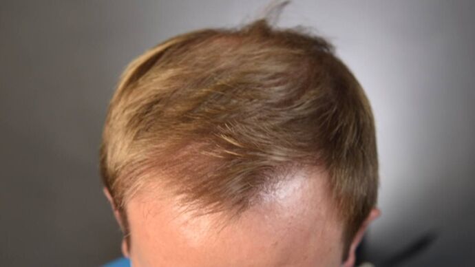 FUT Hair Restoration: Case 12 - After