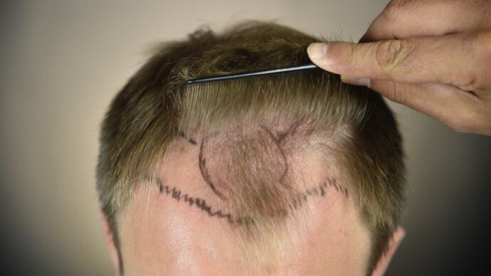 FUT Hair Restoration: Case 12 - Before