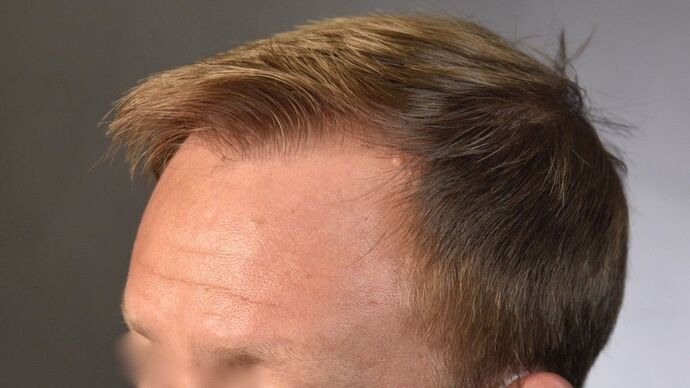 FUT Hair Restoration: Case 12 - After