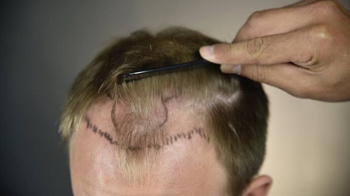 FUT Hair Restoration: Case 12 - Before