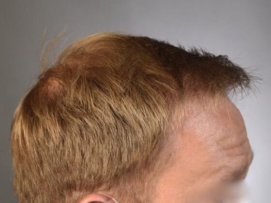 FUT Hair Restoration: Case 12 - After