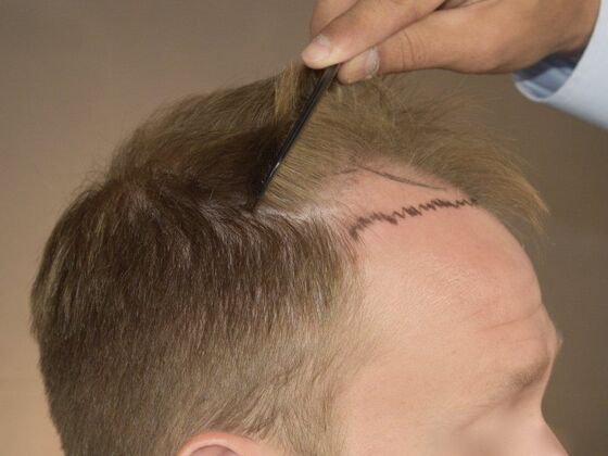 FUT Hair Restoration: Case 12 - Before