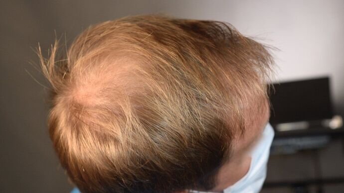 FUT Hair Restoration: Case 12 - After