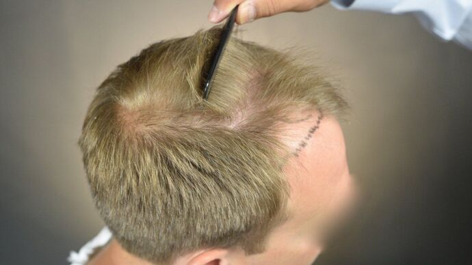 FUT Hair Restoration: Case 12 - Before