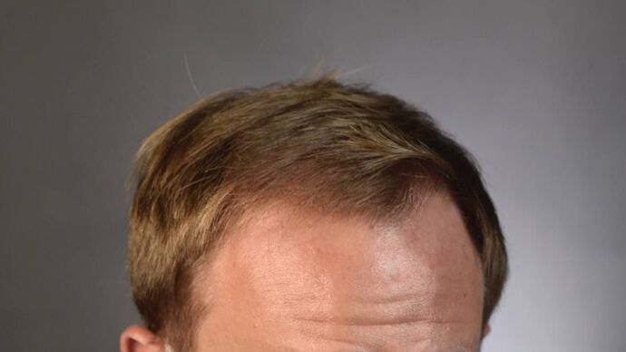 FUT Hair Restoration: Case 12 - After