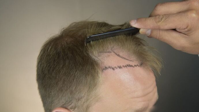 FUT Hair Restoration: Case 12 - Before