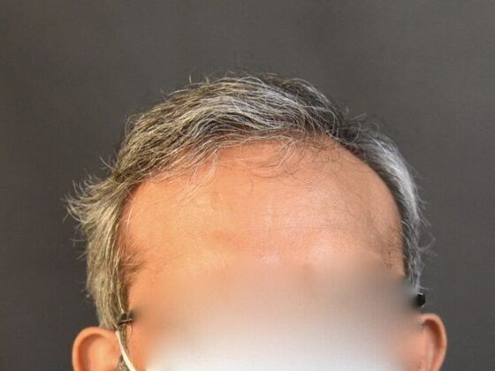 FUT Hair Restoration Case 13 - After