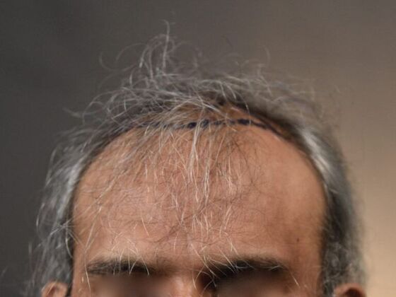 FUT Hair Restoration Case 13 - Before