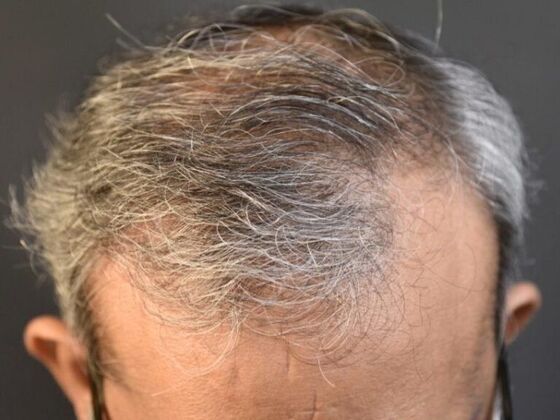 FUT Hair Restoration: Case 13 - After