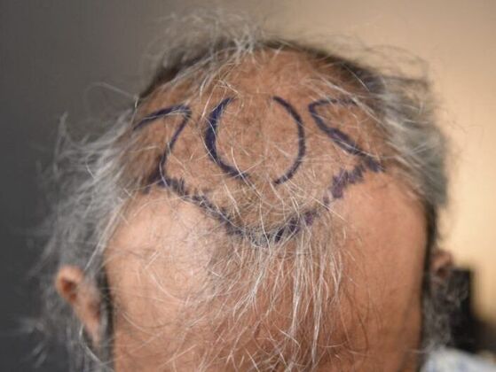 FUT Hair Restoration: Case 13 - Before