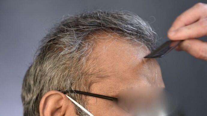 FUT Hair Restoration: Case 13 - After