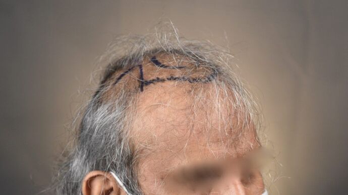 FUT Hair Restoration: Case 13 - Before