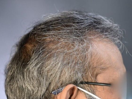 FUT Hair Restoration: Case 13 - After