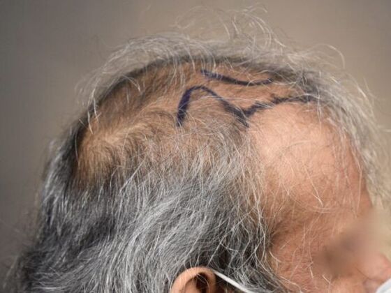 FUT Hair Restoration: Case 13 - Before