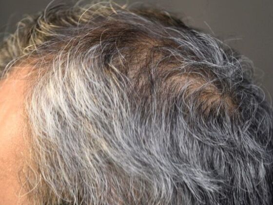 FUT Hair Restoration: Case 13 - After