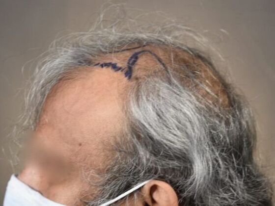 FUT Hair Restoration: Case 13 - Before