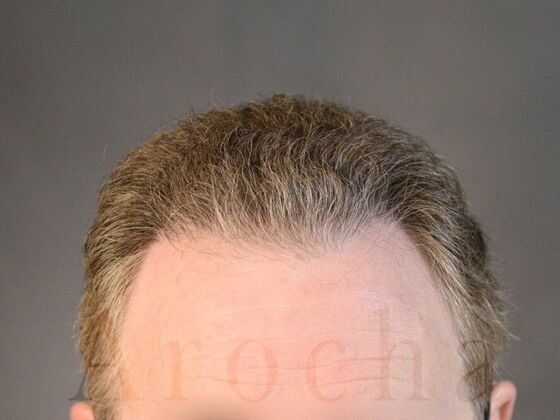 FUT Hair Restoration Case 14 - After