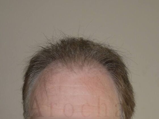 FUT Hair Restoration Case 14 - Before