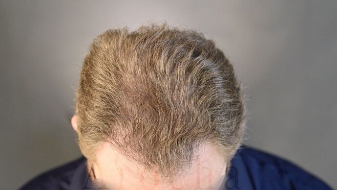 FUT Hair Restoration: Case 14 - After