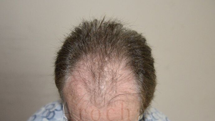 FUT Hair Restoration: Case 14 - Before