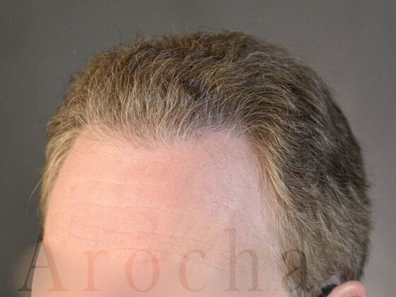 FUT Hair Restoration: Case 14 - After