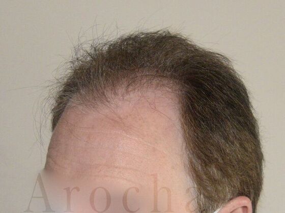 FUT Hair Restoration: Case 14 - Before