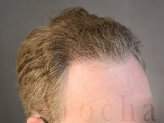 FUT Hair Restoration: Case 14 - After