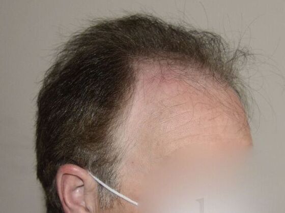 FUT Hair Restoration: Case 14 - Before