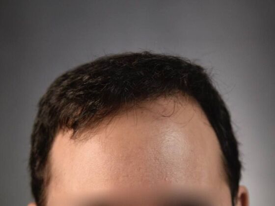 FUT Hair Restoration Case 15 - After