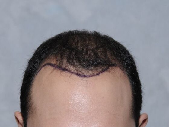FUT Hair Restoration Case 15 - Before
