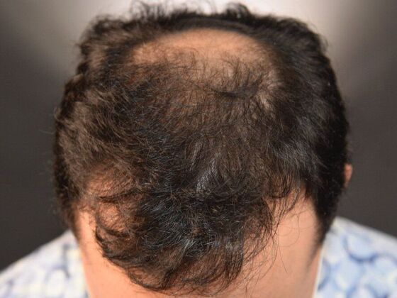 FUT Hair Restoration: Case 15 - After