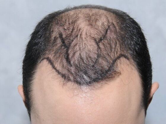 FUT Hair Restoration: Case 15 - Before