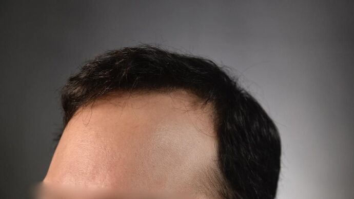 FUT Hair Restoration: Case 15 - After