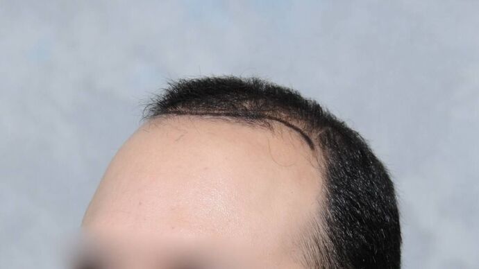 FUT Hair Restoration: Case 15 - Before