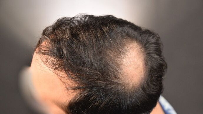 FUT Hair Restoration: Case 15 - After