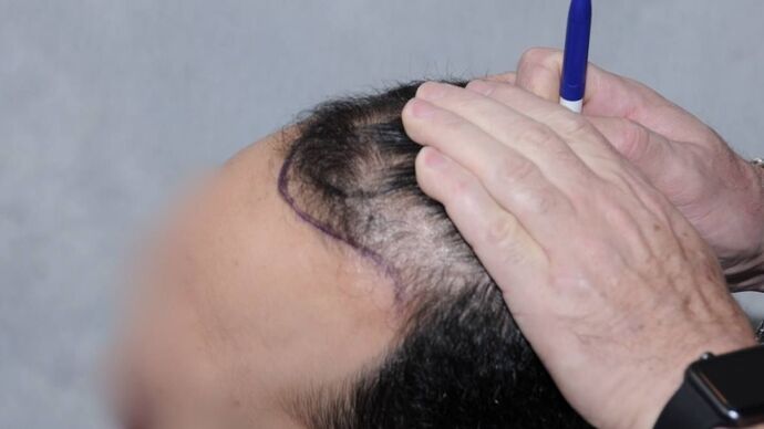 FUT Hair Restoration: Case 15 - Before