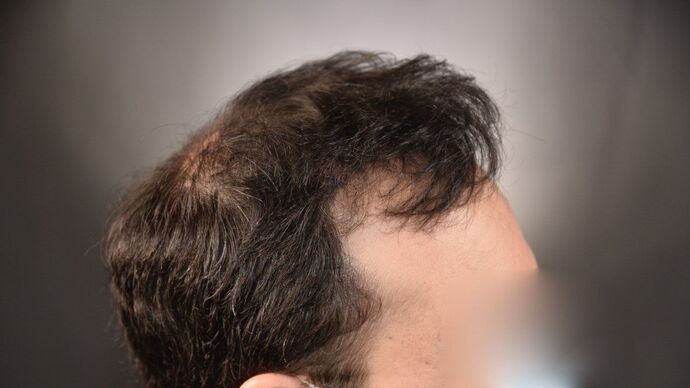 FUT Hair Restoration: Case 15 - After