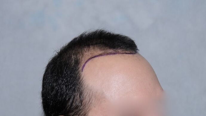 FUT Hair Restoration: Case 15 - Before