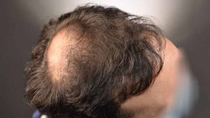 FUT Hair Restoration: Case 15 - After