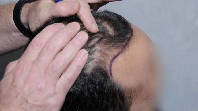 FUT Hair Restoration: Case 15 - Before